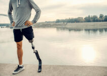 Amputated arm, leg Amputated arm, leg